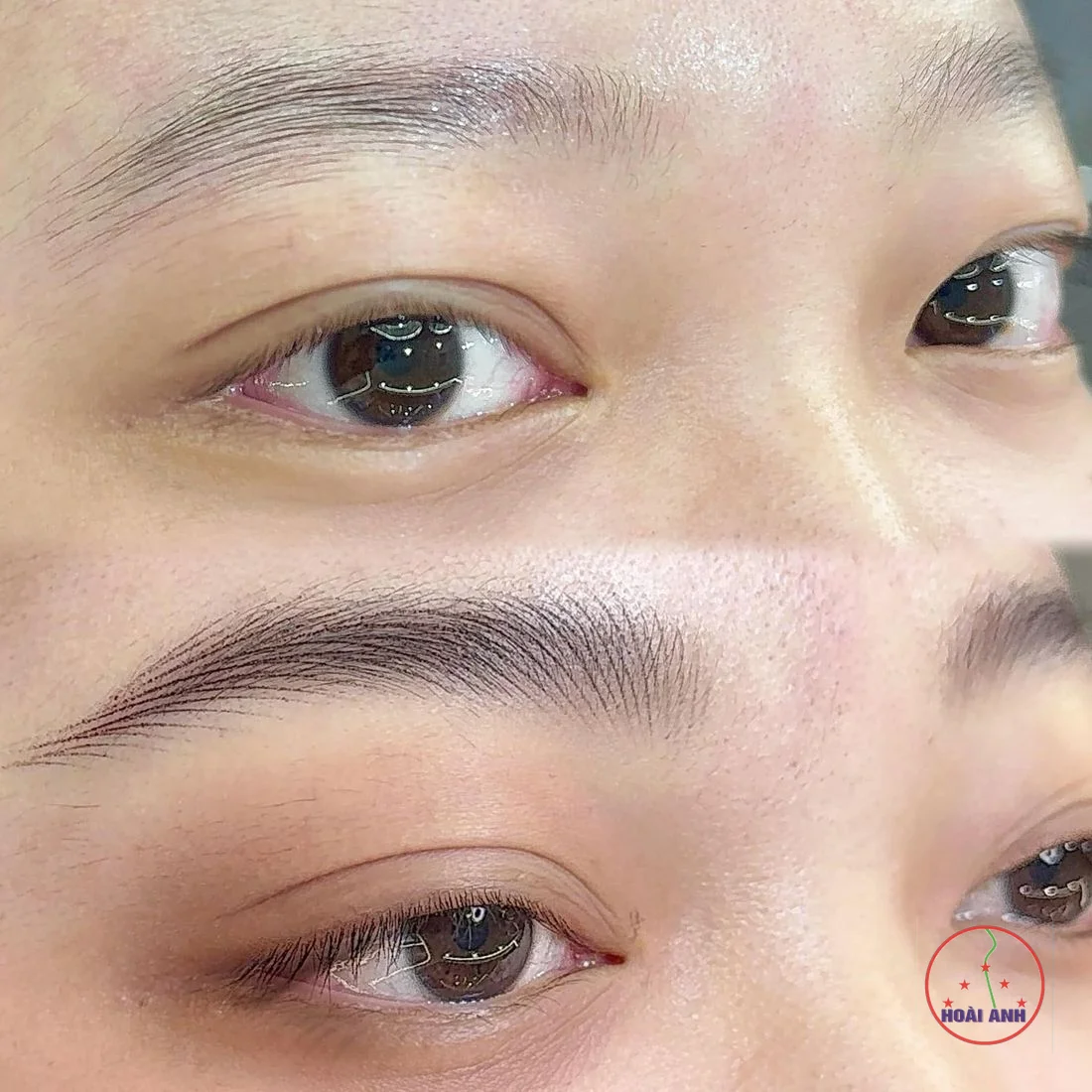 Phun thẩm mỹ giữ được bao lâu?