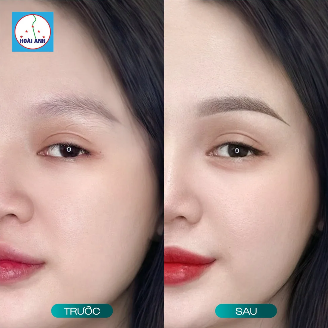 Phun môi bong vảy mấy ngày thì đẹp?