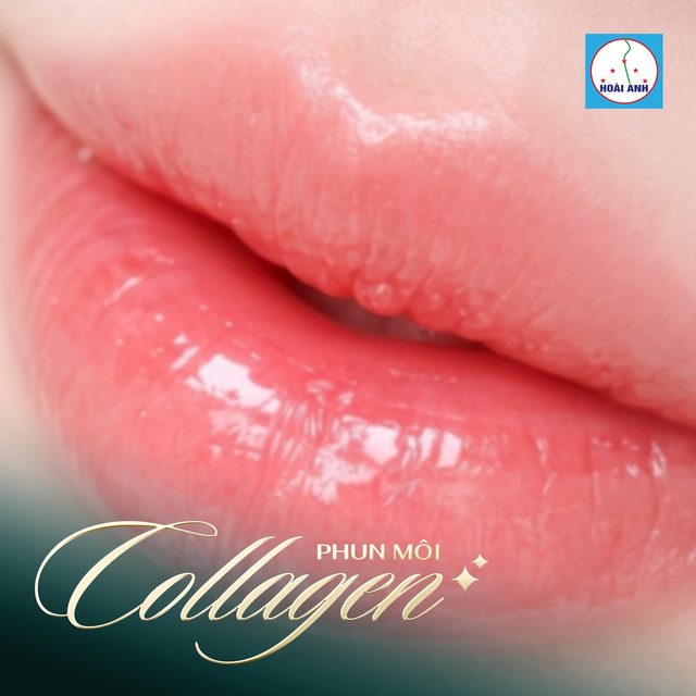 Phun môi Collagen — kết quả tại Hoài Anh