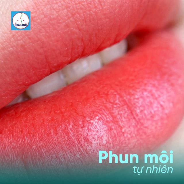 Phun môi Hồng tự nhiên — kết quả tại Hoài Anh